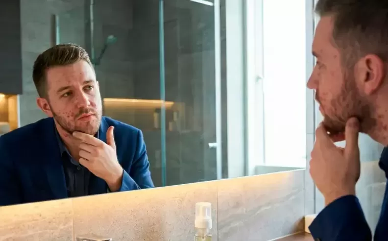 روتين حب الشباب الذي يغير بشرتك فعلا ويمنحك ثقة واضحة دون تدمير الوجه